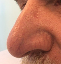 Basal Cell Carcinoma