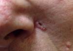 Basal Cell Carcinoma