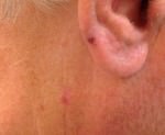 Basal Cell Carcinoma