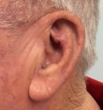 Basal Cell Carcinoma