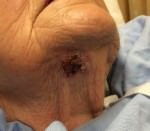 Basal Cell Carcinoma