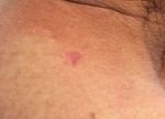 Basal Cell Carcinoma