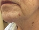 Basal Cell Carcinoma