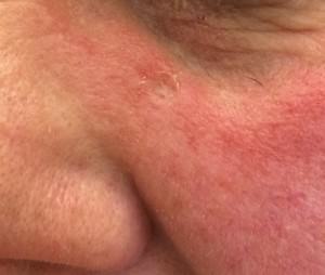 Basal Cell Carcinoma