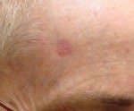 Basal Cell Carcinoma