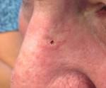Basal Cell Carcinoma