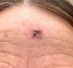 Basal Cell Carcinoma
