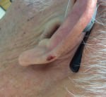 Basal Cell Carcinoma