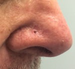 Basal Cell Carcinoma