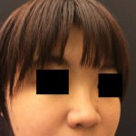 Restylane and Perlane