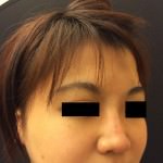 Restylane and Perlane