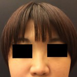 Restylane and Perlane