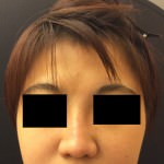 Restylane and Perlane