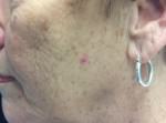 Basal Cell Carcinoma