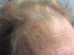 Basal Cell Carcinoma