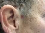 Basal Cell Carcinoma