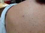 Dysplastic Nevus