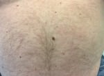 Dysplastic Nevus