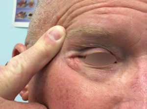 Basal Cell Carcinoma