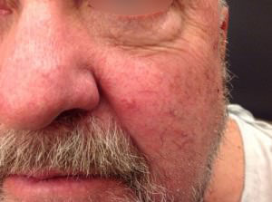 Basal Cell Carcinoma
