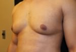 Gynecomastia