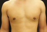 Gynecomastia