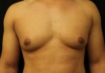 Gynecomastia