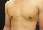 Gynecomastia