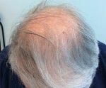 NeoGraft