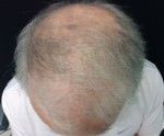NeoGraft