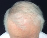 NeoGraft