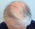 NeoGraft