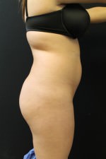 Liposuction
