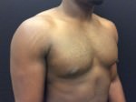 Gynecomastia