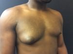 Gynecomastia