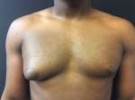 Gynecomastia
