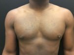 Gynecomastia