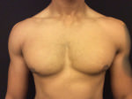 Gynecomastia
