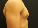 Gynecomastia