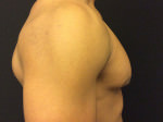 Gynecomastia