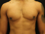 Gynecomastia