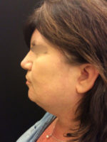 Neck Lift