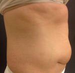 Liposuction