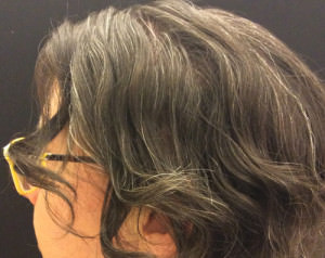 Scalp Reconstruction