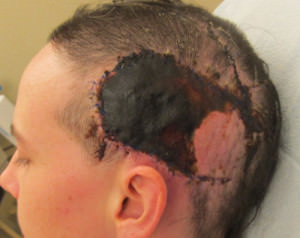 Scalp Reconstruction
