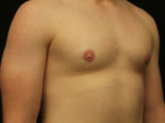 Gynecomastia