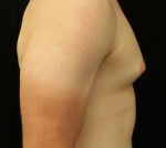 Gynecomastia