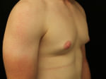 Gynecomastia