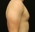 Gynecomastia