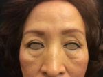 Eyelid Surgery